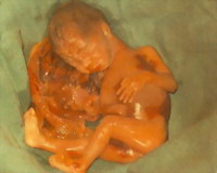 aborto_d01